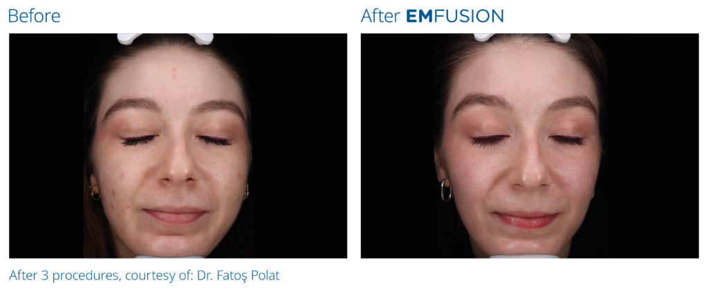 Emfusion_PIC_Ba-card-female-009_PL100