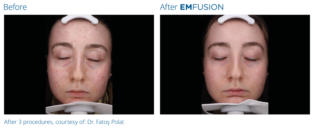 Emfusion_PIC_Ba-card-female-015_PL100