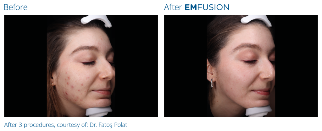 Emfusion_PIC_Ba-card-female-016_PL100