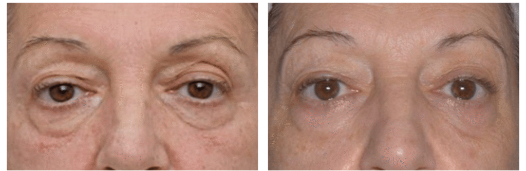 Exion_PIC_Ba-card-eyes-female-060_Face_PL100