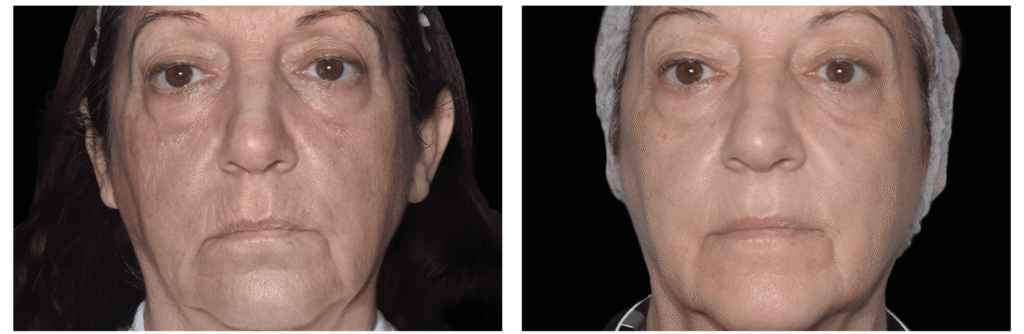 Exion_PIC_Ba-card-face-female-060_Face_PL100