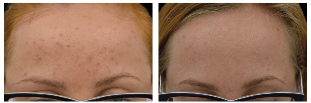 Exion_PIC_Ba-card-forehead-female-064_FRF_PL100